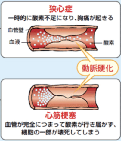 虚血性心疾患 治療 手術 合併症について ツカザキ病院