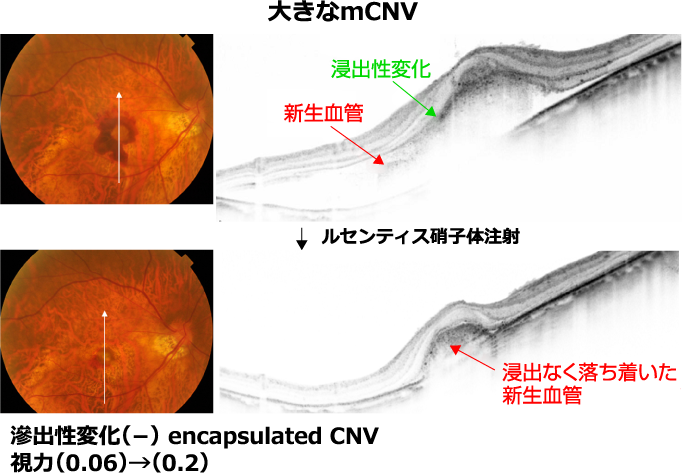 強度近視眼底 症状 原因 合併症 治療 手術について 眼科 ツカザキ病院
